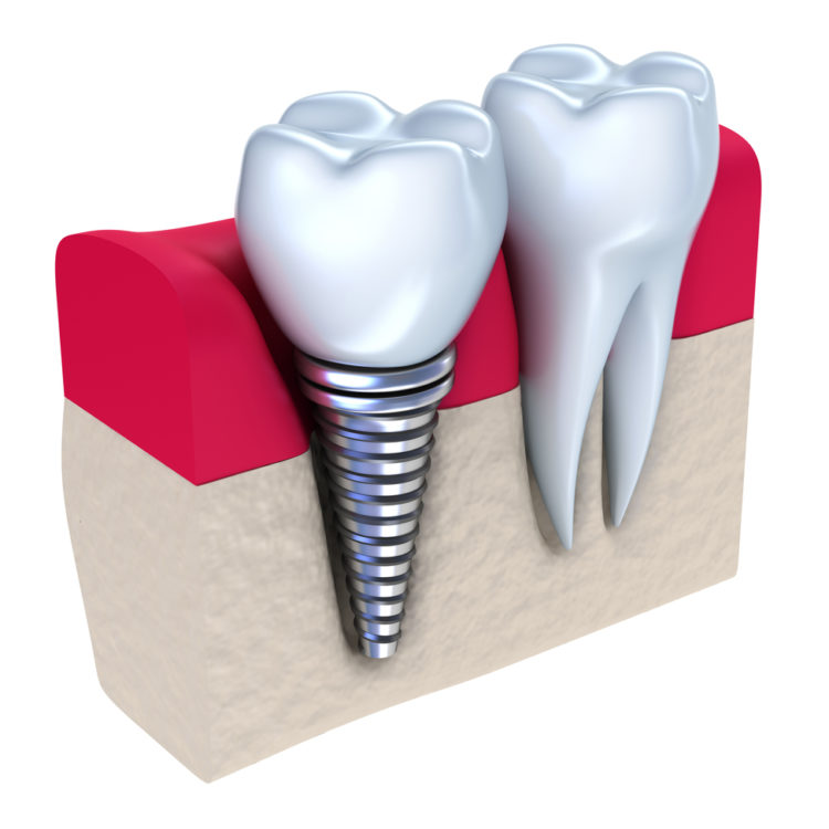 graphic of dental crown