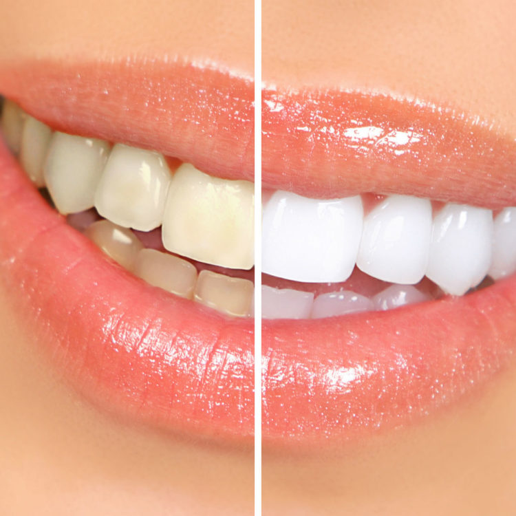 before and after tooth whitening